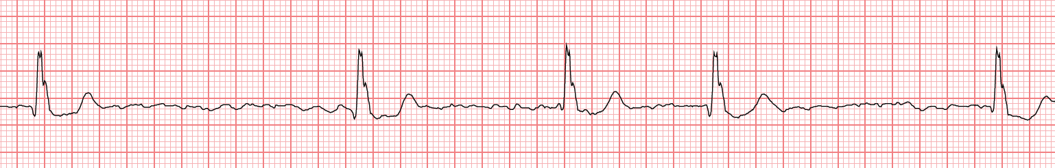 wavy garbage with NO P waves = atrial fibrillation (usually)