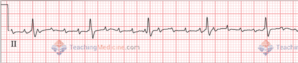 abnormal PR interval