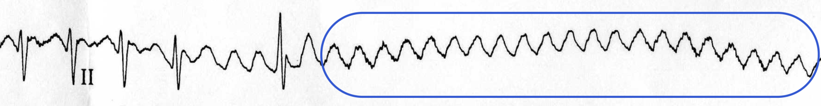 sawtooth pattern