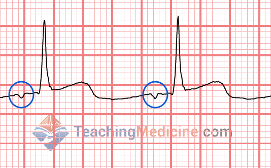 inverted P waves