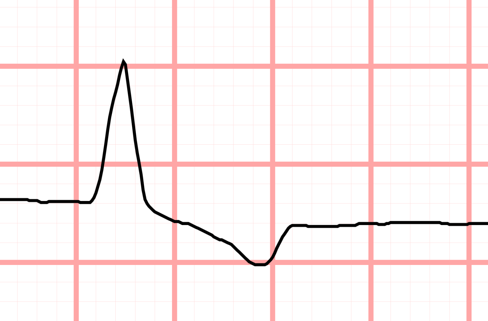 J point ECG