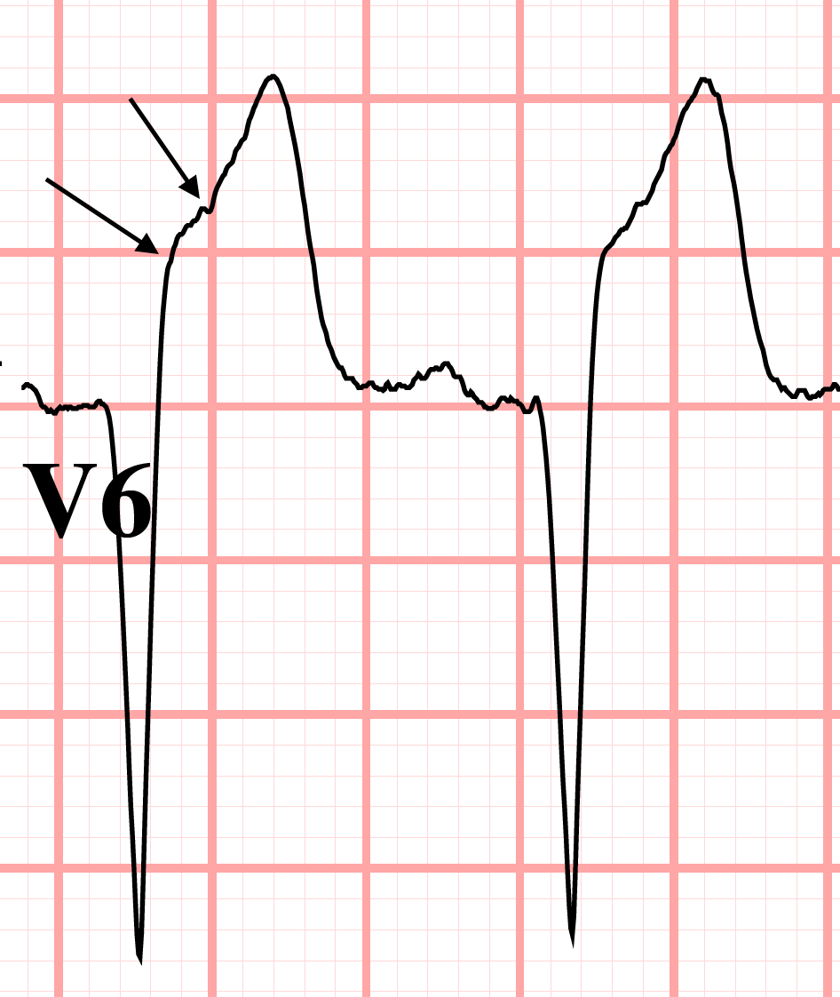 J point elevation