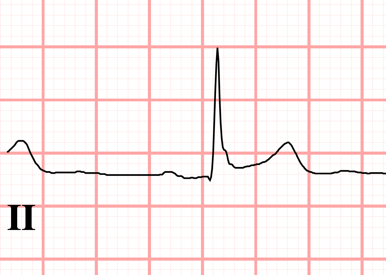 J point slurring