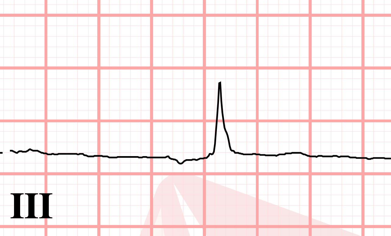 J point ECG