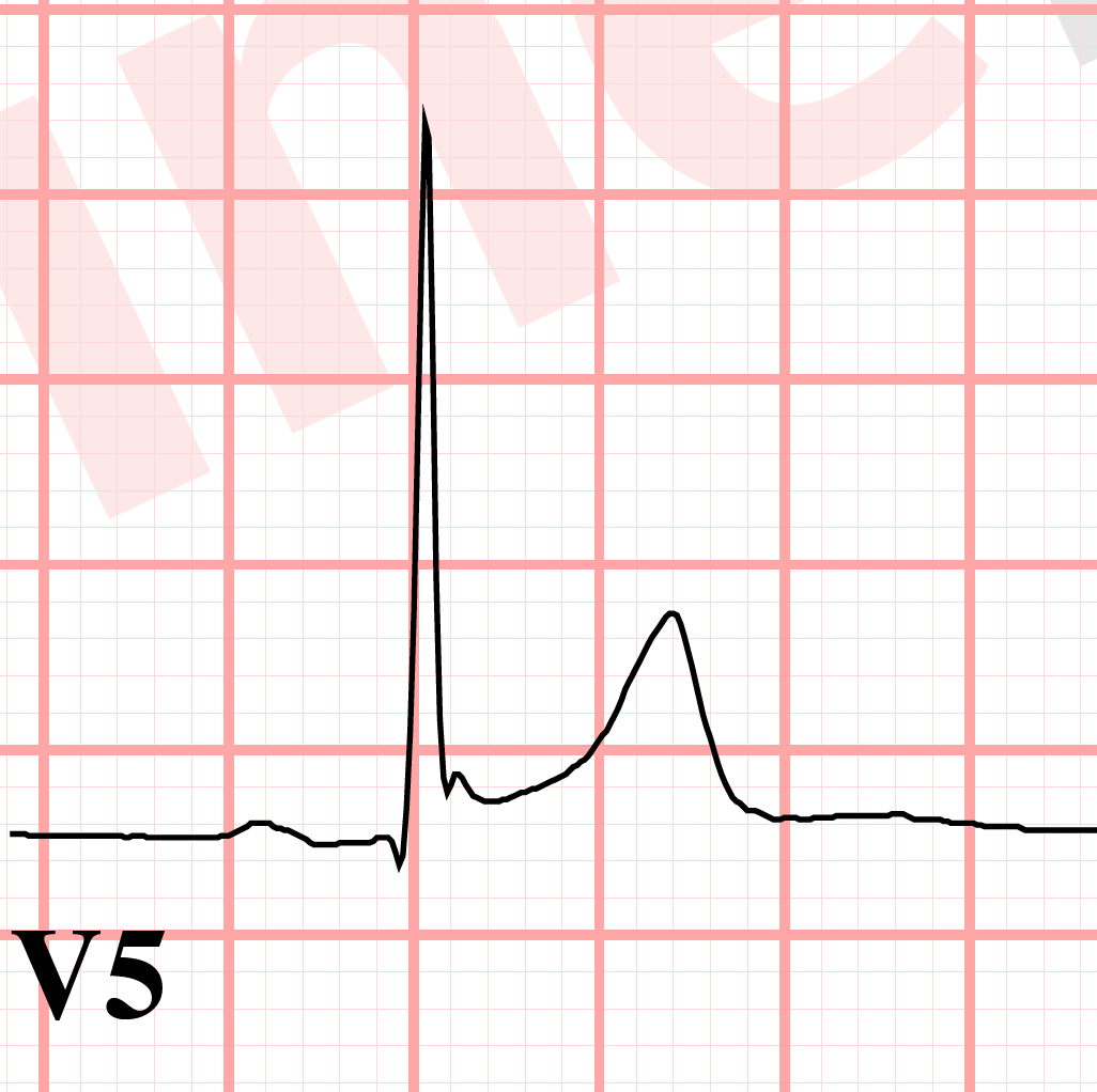 J point notching ECG