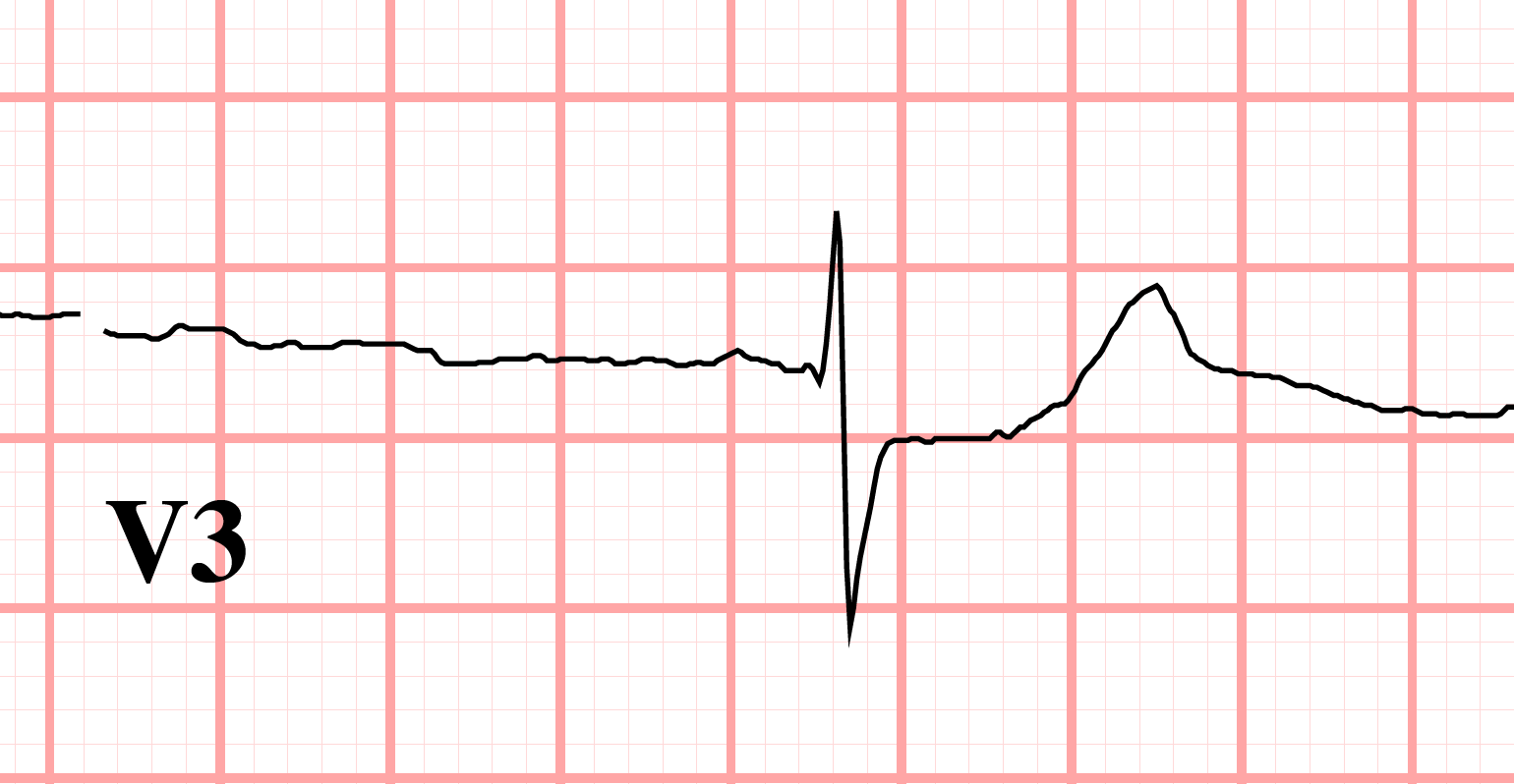 J point depression ECG