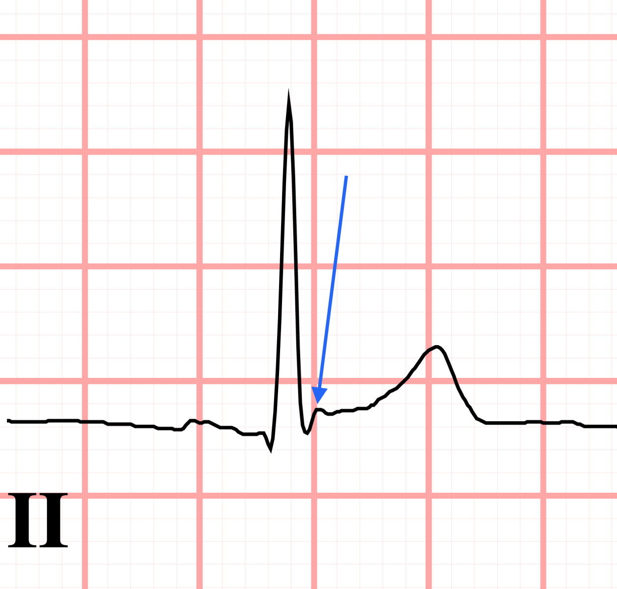 J point notching ECG