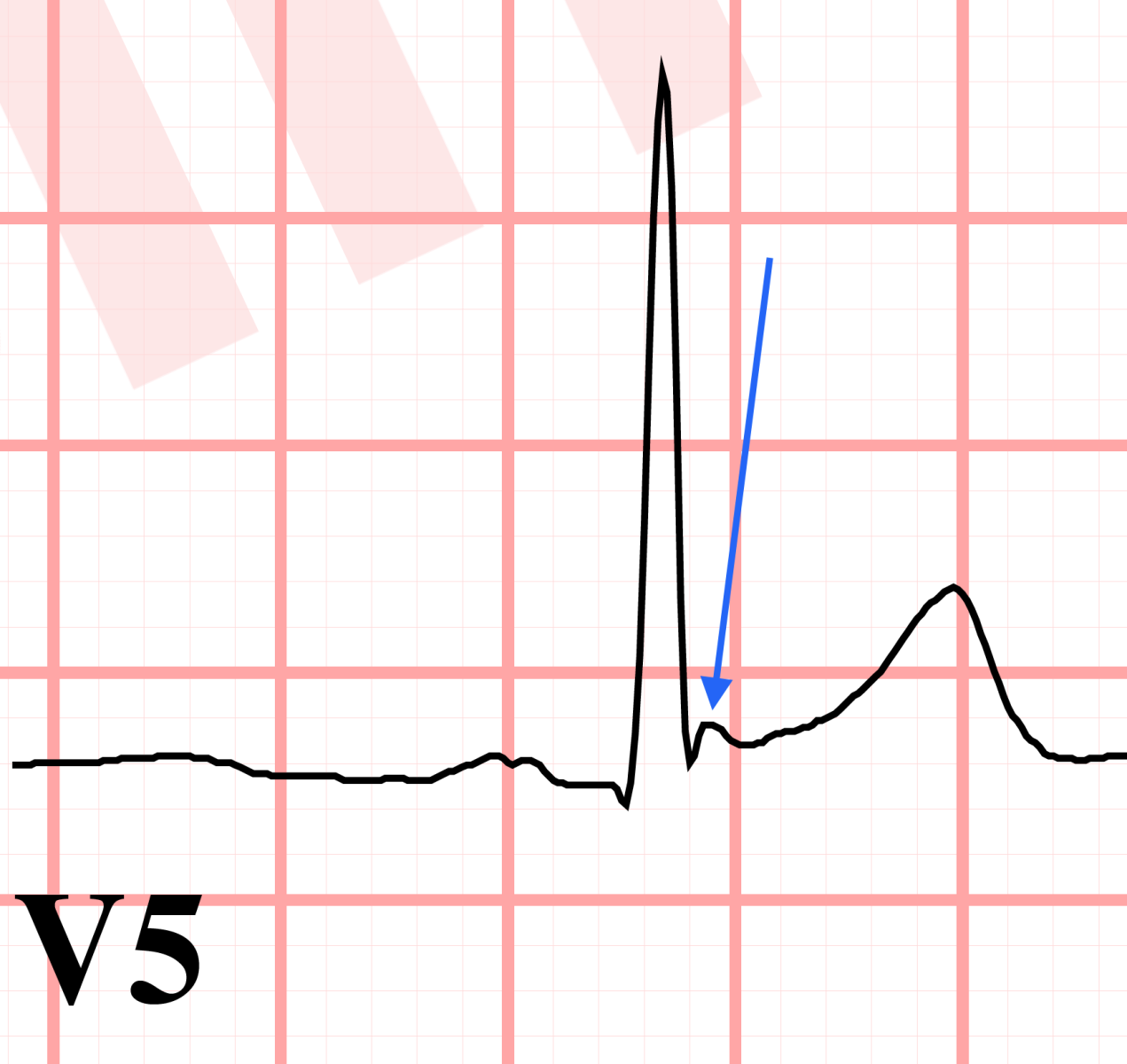 J point notching ECG