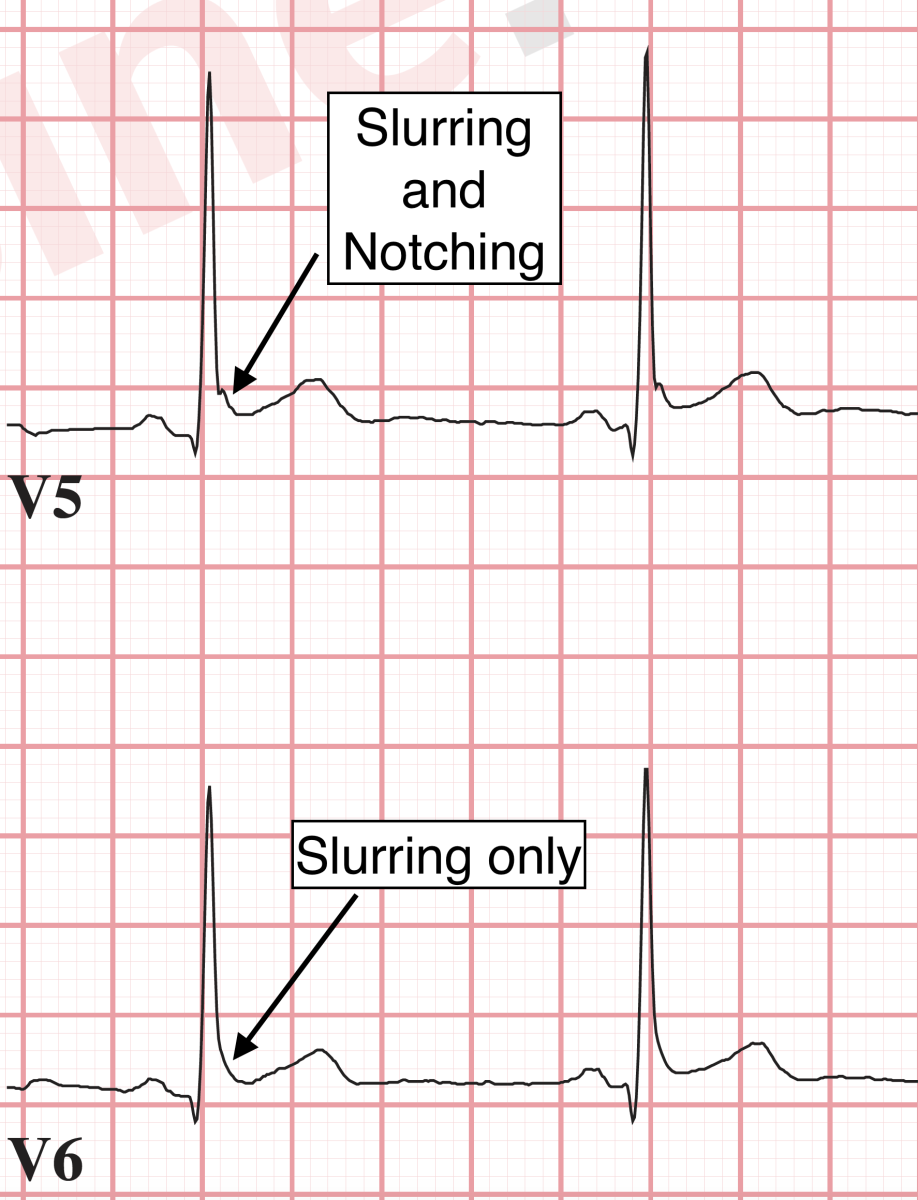 J point notching and slurring