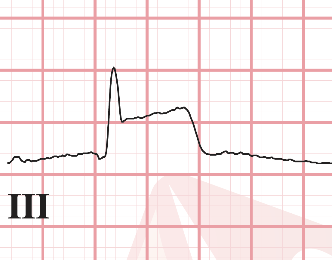 J point elevation ECG