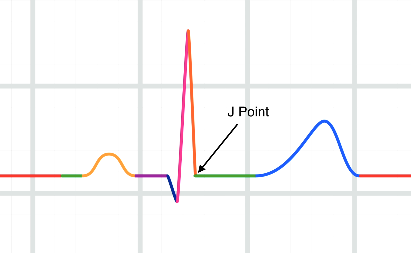 J point ECG