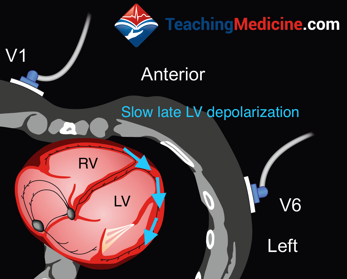 LBBB ECG