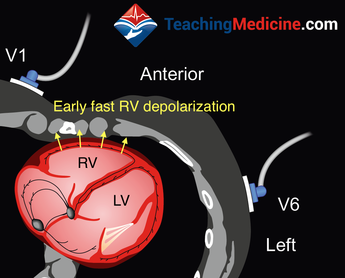 understanding LBBB