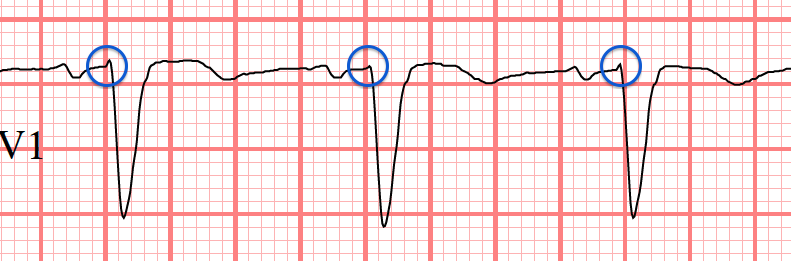 LBBB ECG