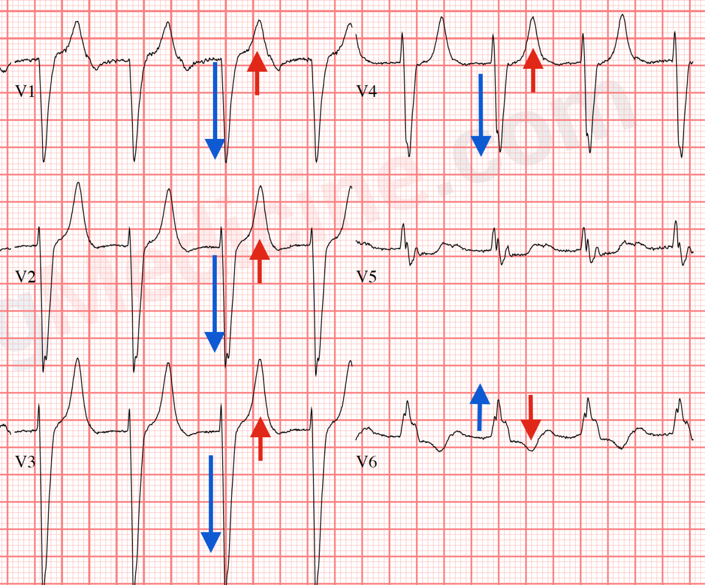 LBBB ECG