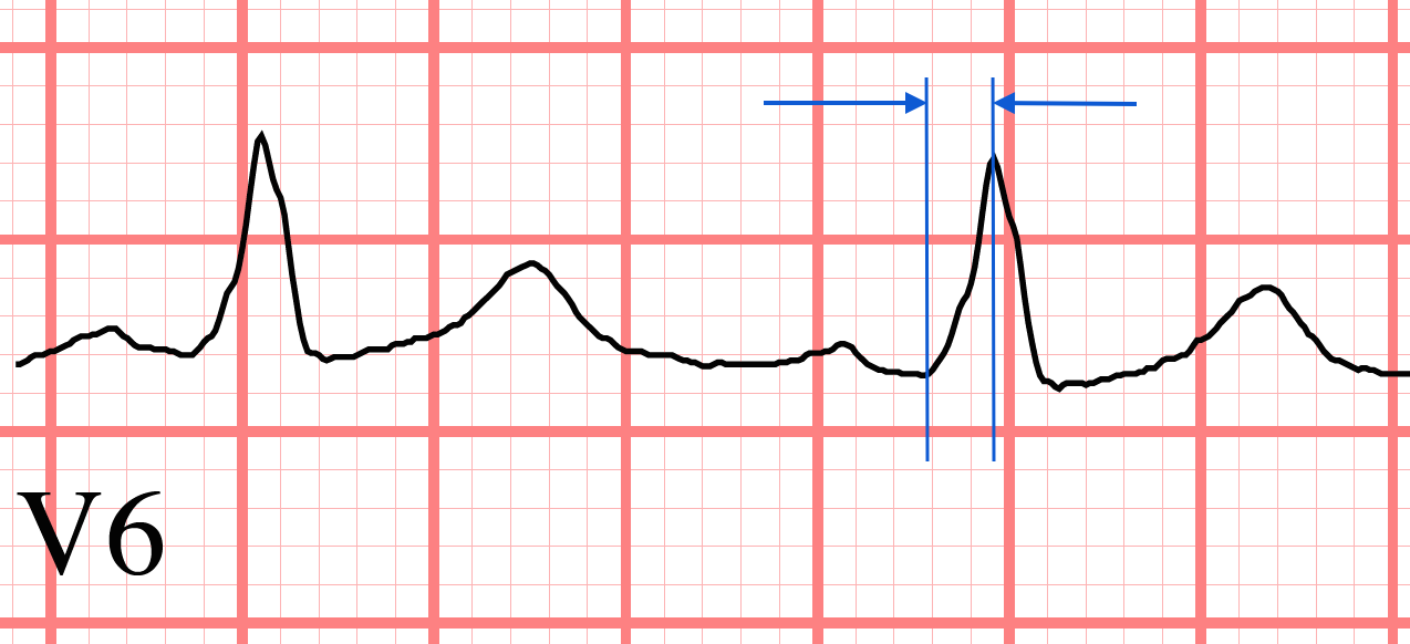 LBBB ECG