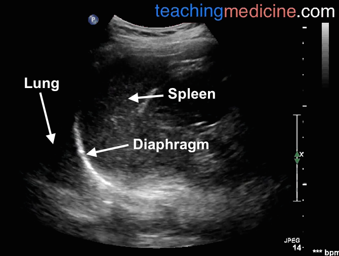 spleen on ultrasound