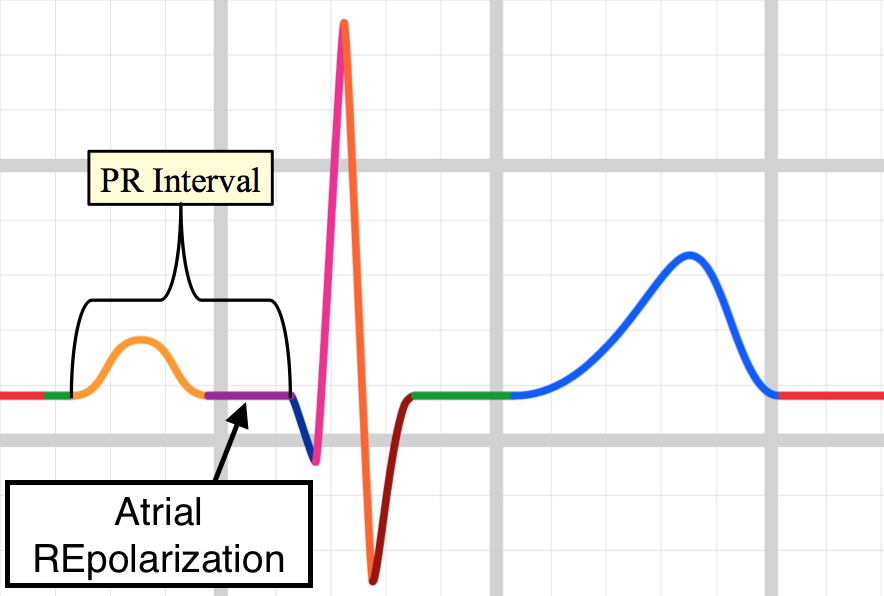 PR segment pericarditis