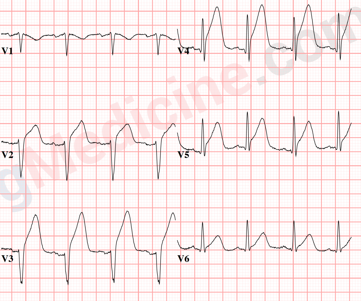 peaked T waves