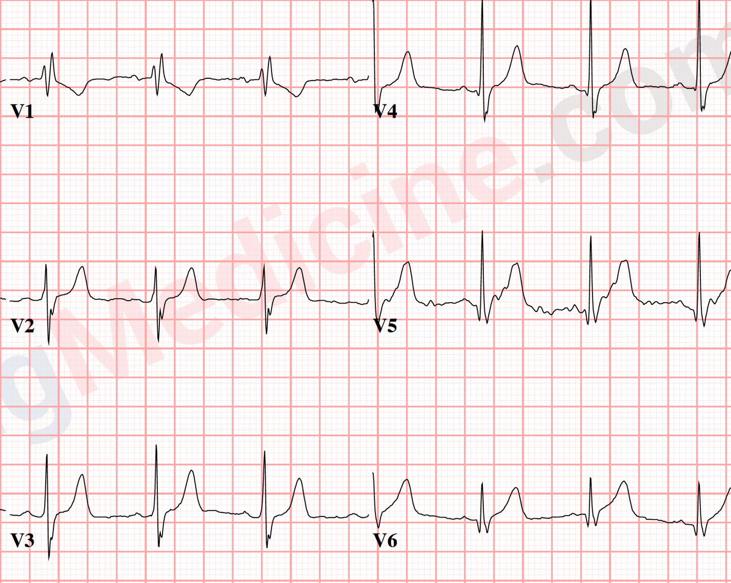 peaked T waves