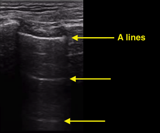 A lines on ultrasound