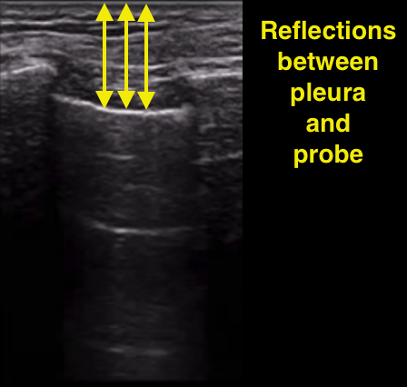 A lines on ultrasound