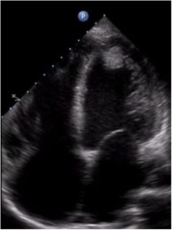 ultrasound of heart