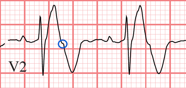 ST segment RBBB