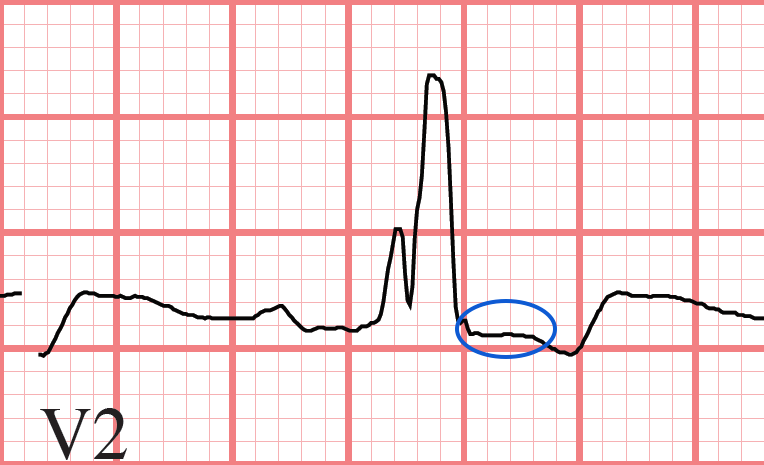 ST segment RBBB