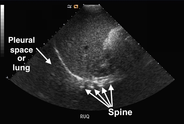 spine on ultrasound