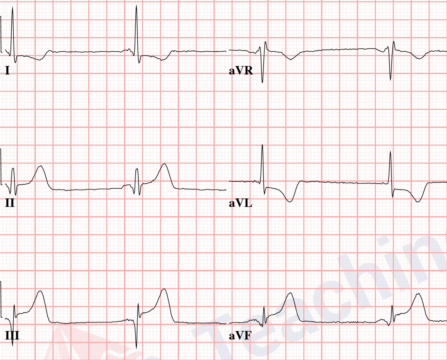 reciprocal ECG depression