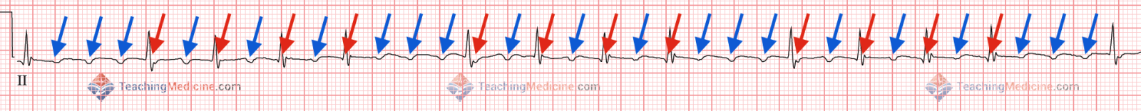 many P waves, red arrows are hidden P waves