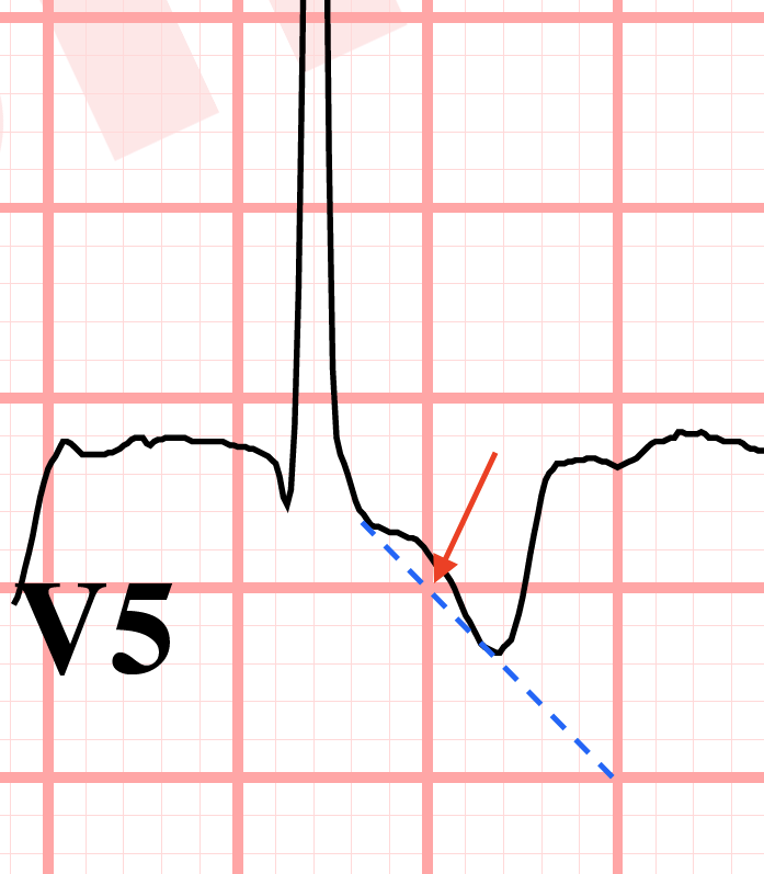 ST segment depression