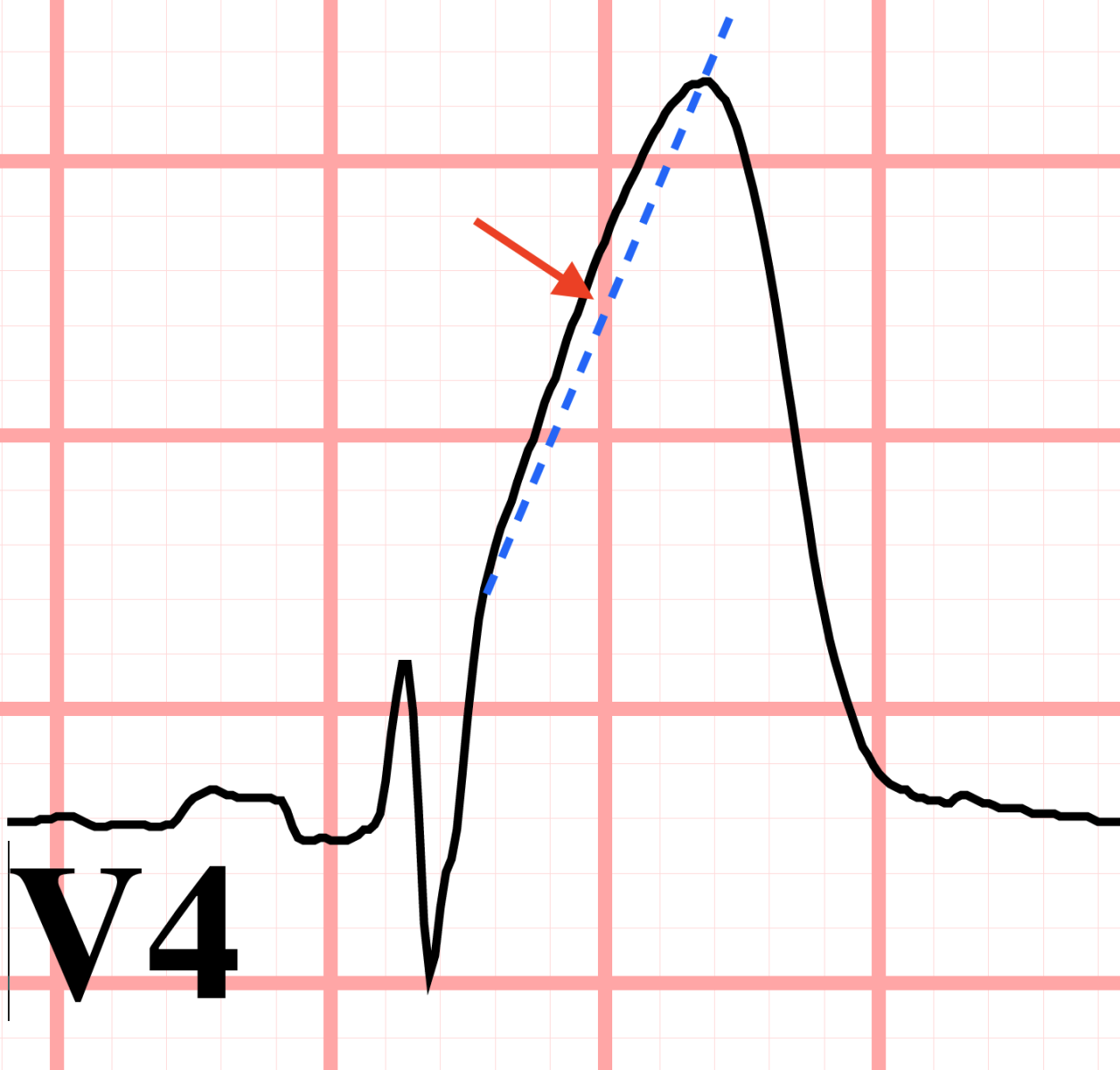 ST segment elevation