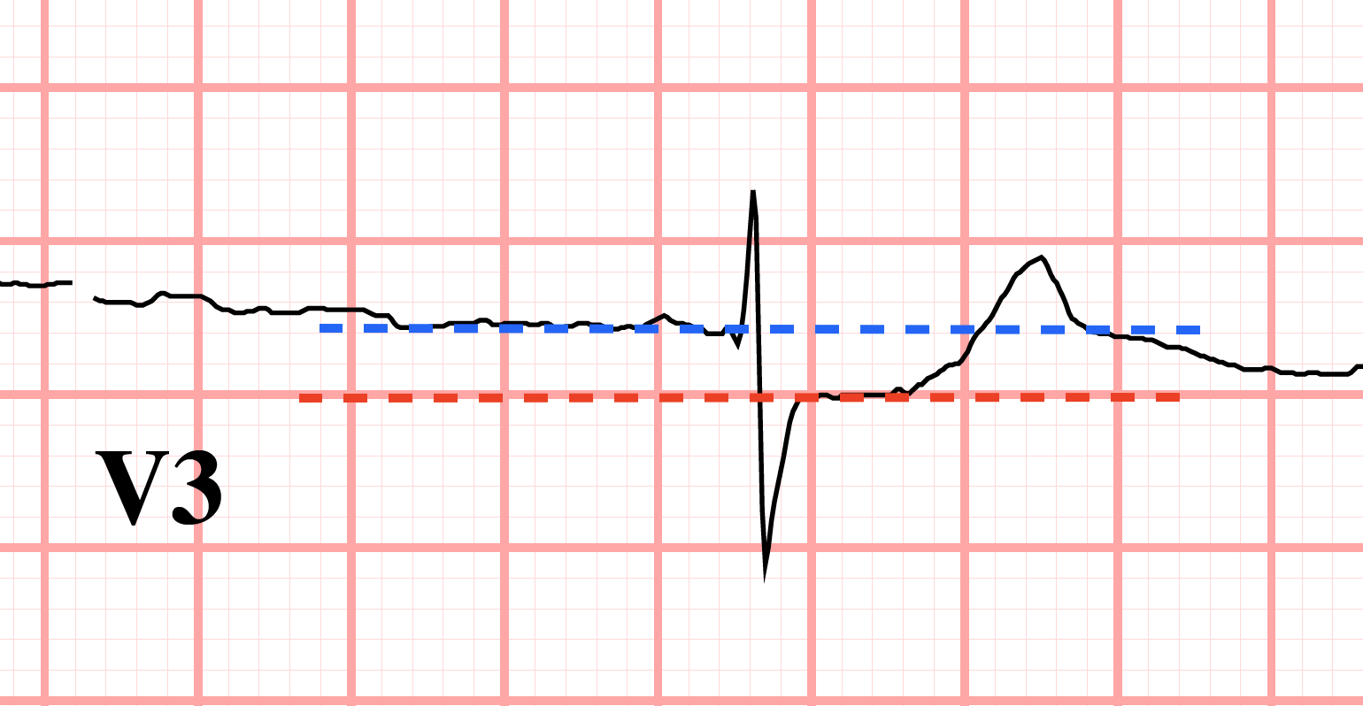 ST segment depression