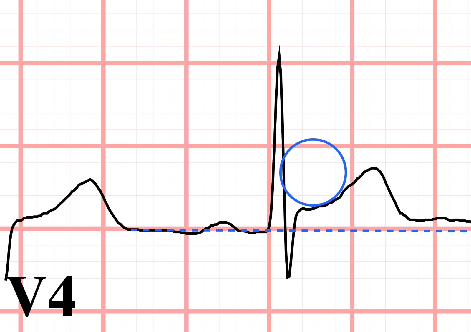 ST elevation pericarditis