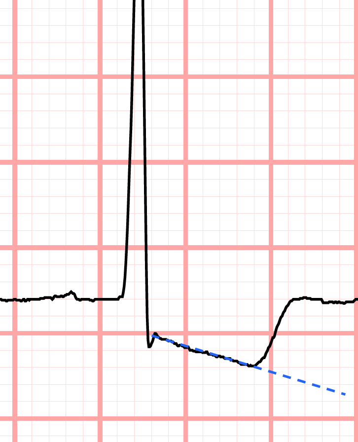 ST segment depression