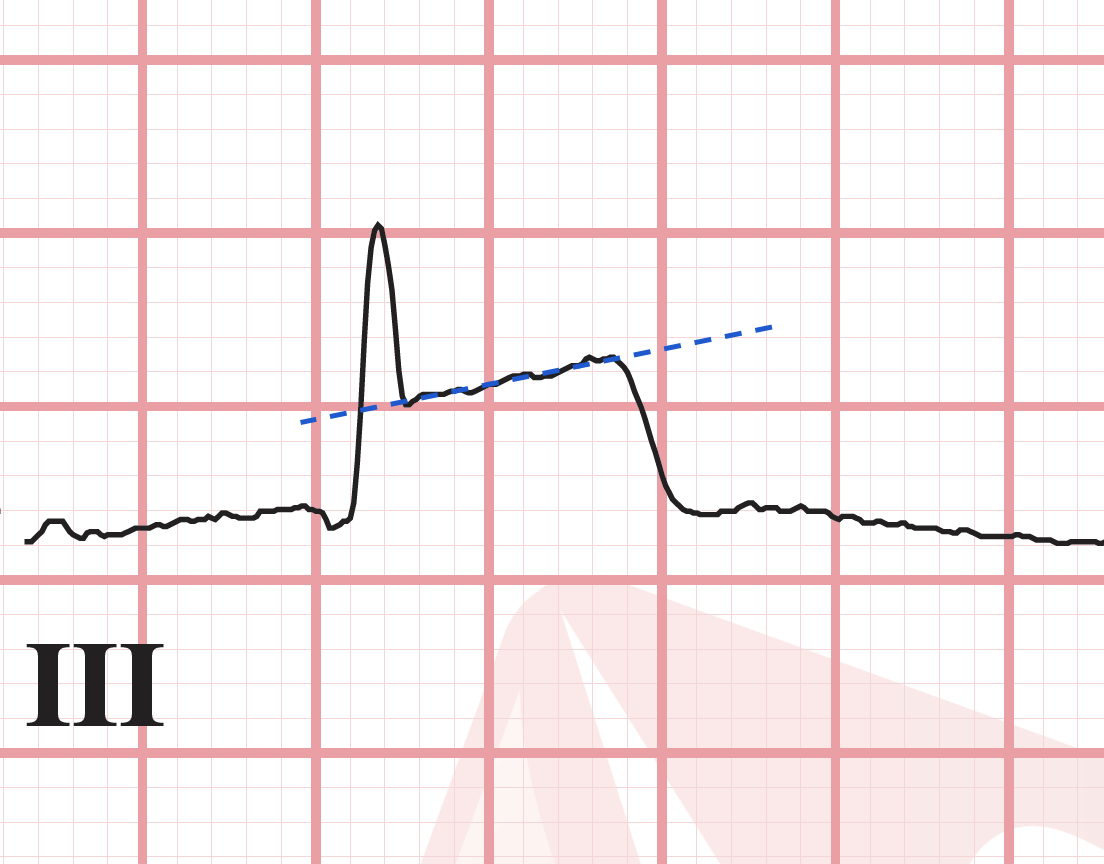 ST segment elevation