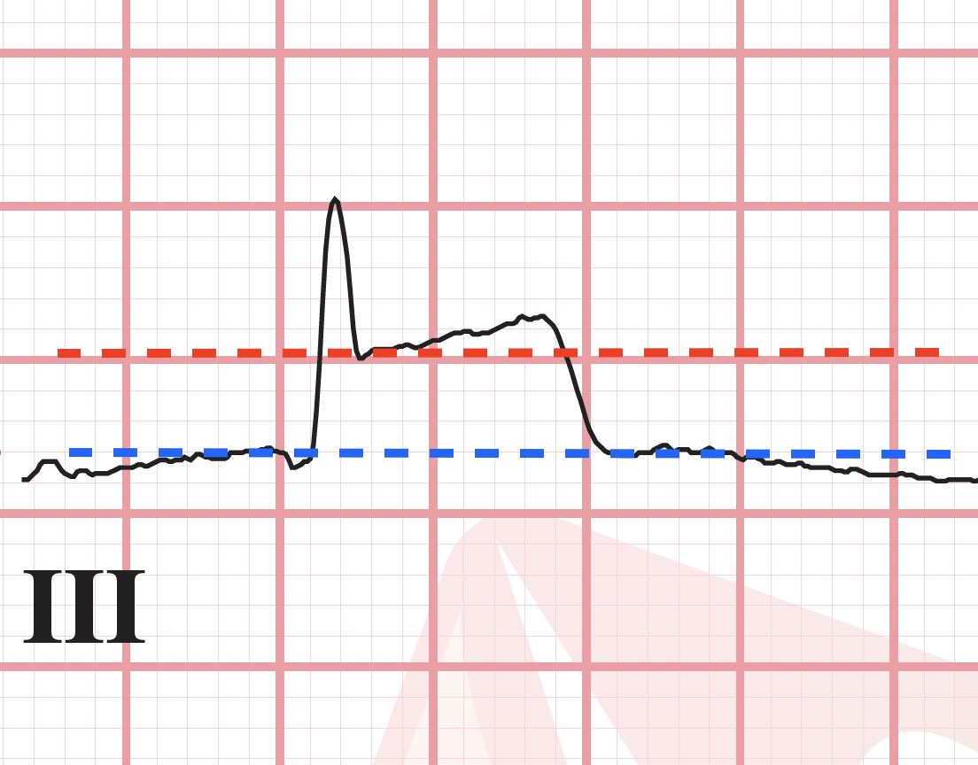 ST segment elevation