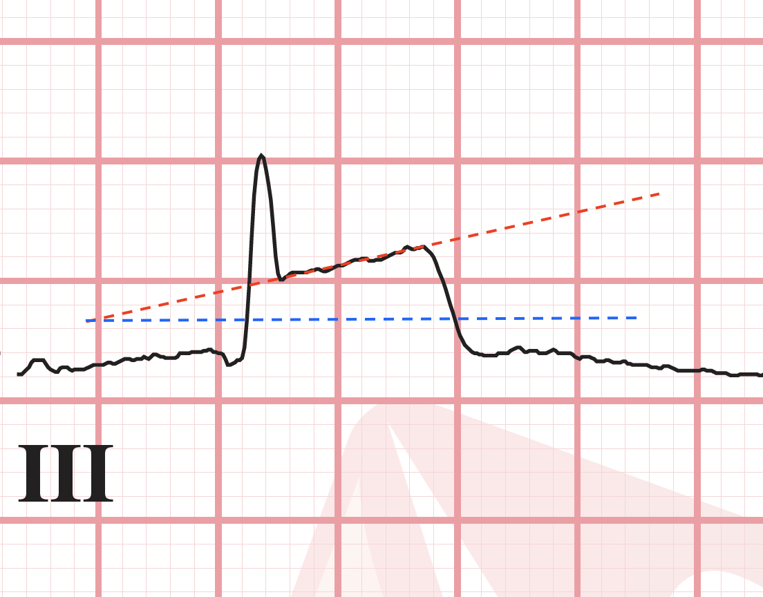 ST elevation