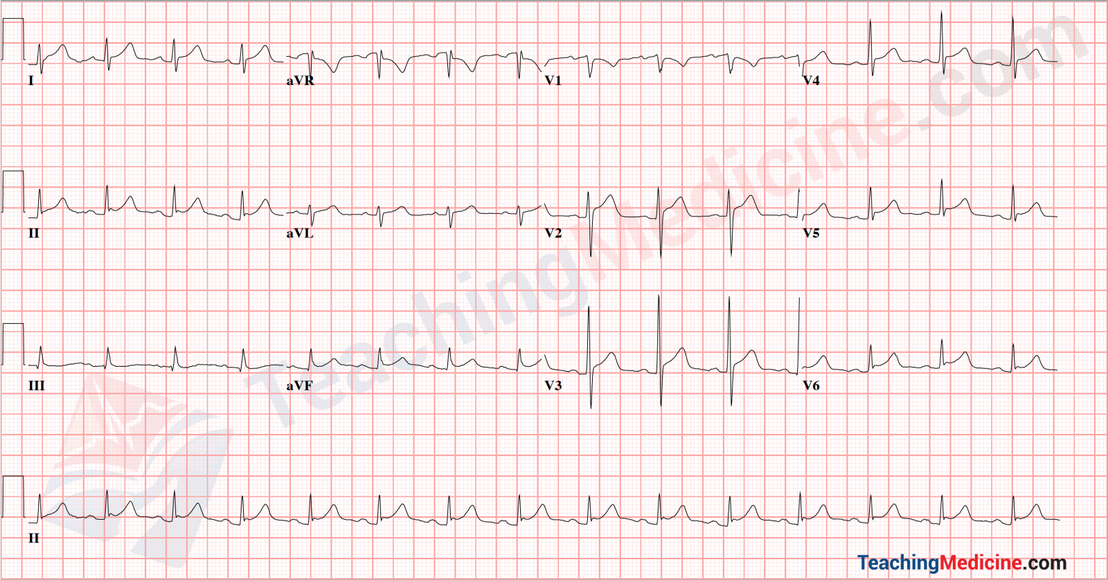 pericarditis example