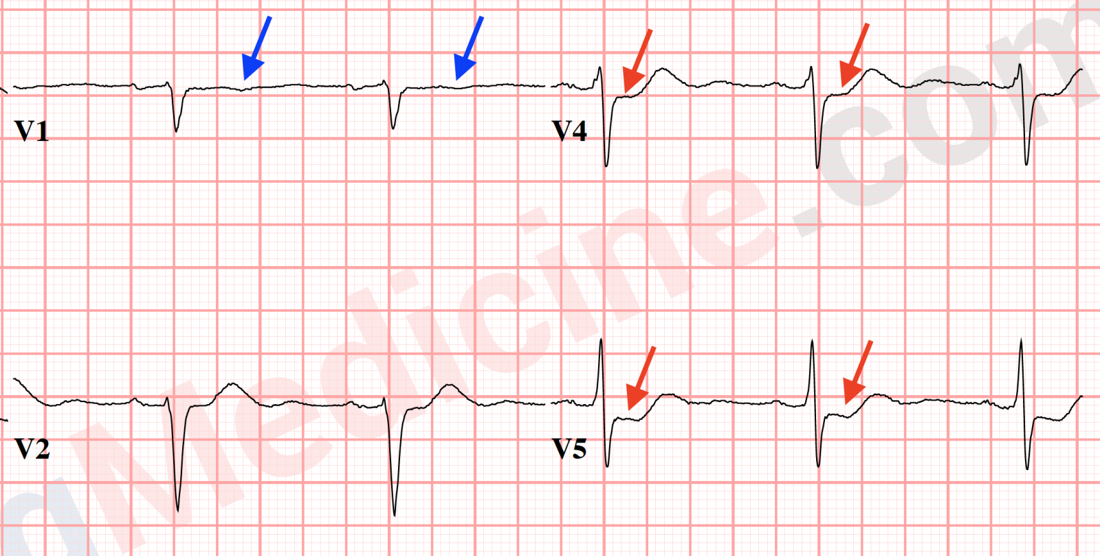 ST segment elevation