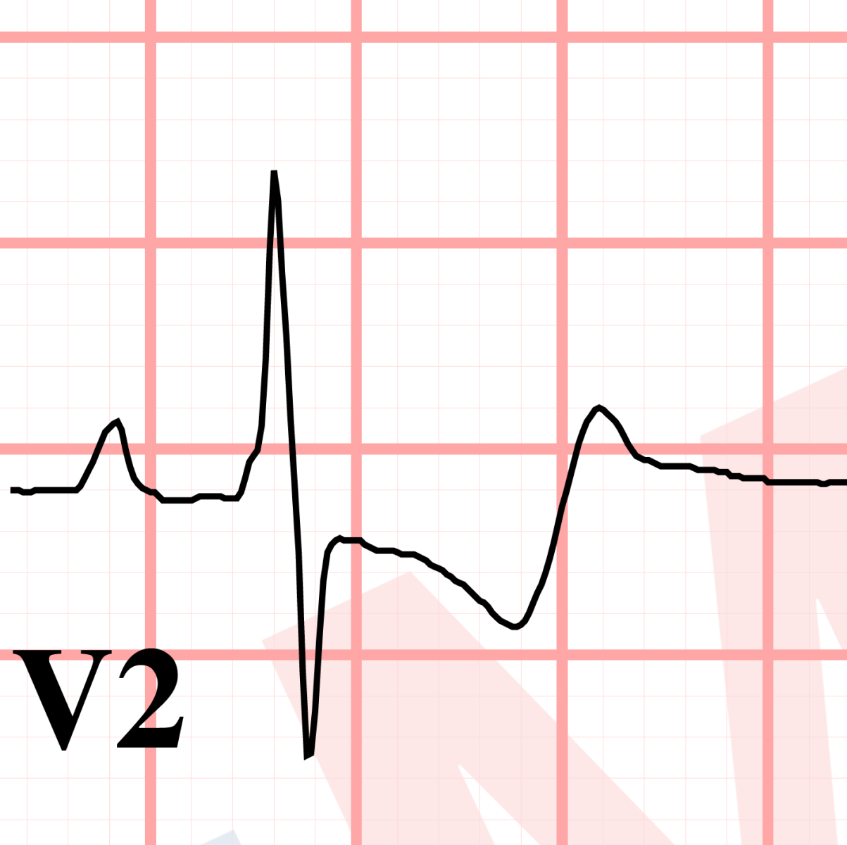 biphasic T wave