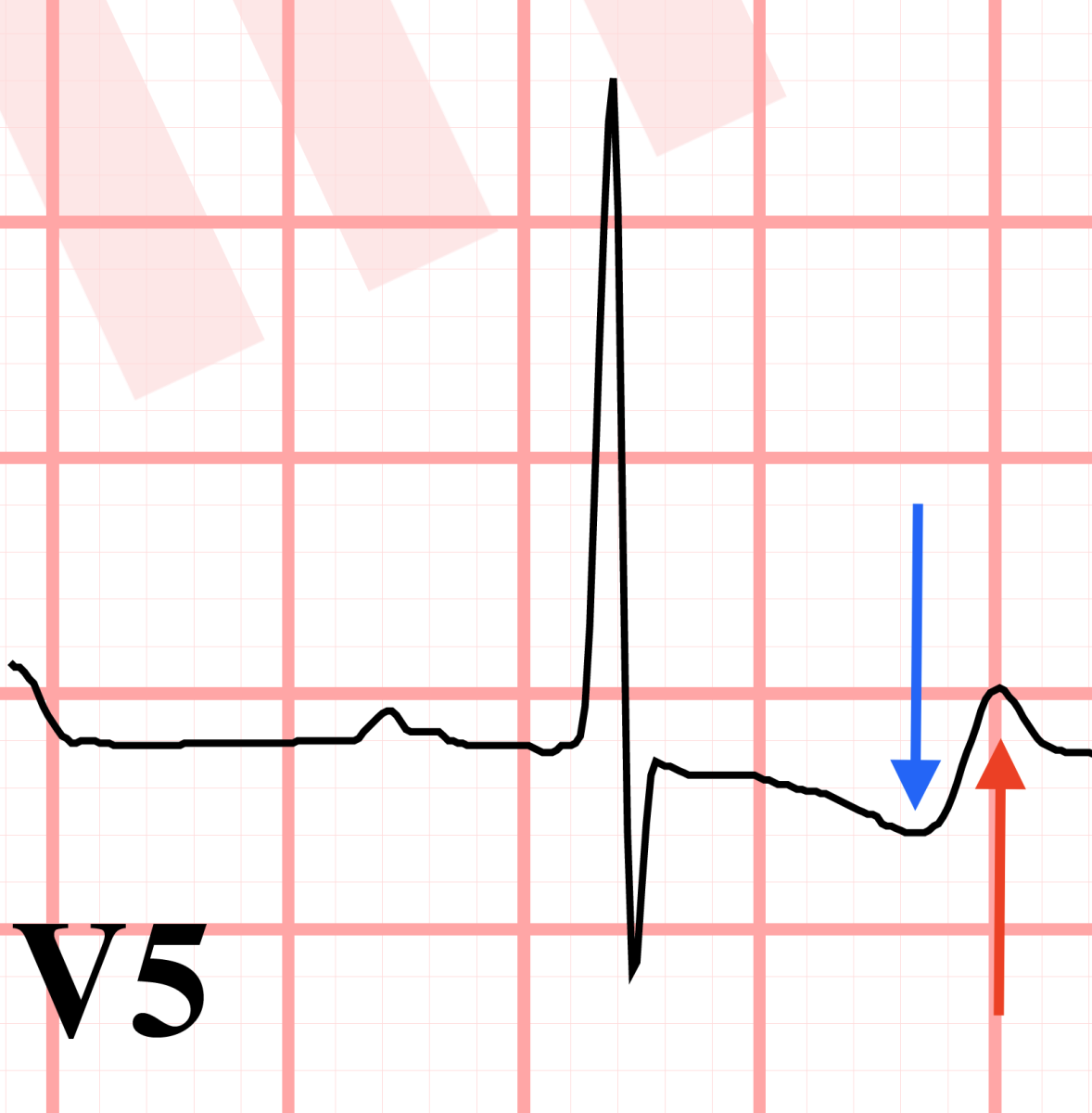 biphasic T wave