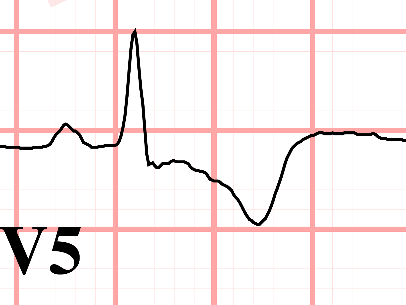 inverted T wave