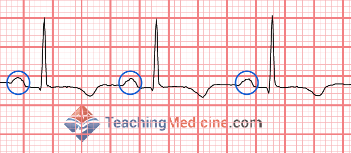 upright P waves