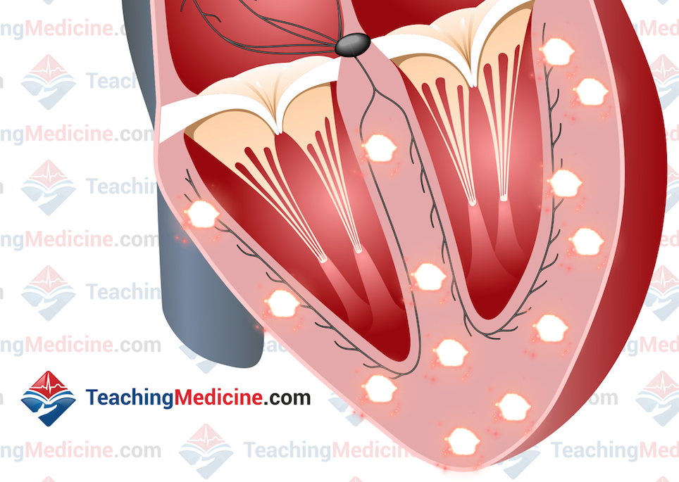 multiple ventricular ectopic pacemakers