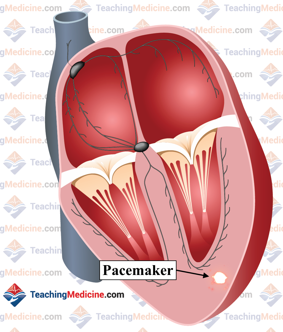 ventricular tachycardia also known as VT, is caused by a pacemaker in the ventricles